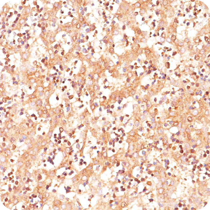 AFP (Alpha Fetoprotein) (Hepatocellular/Germ Cell Tumor Marker); Clone C3 (Concentrate)