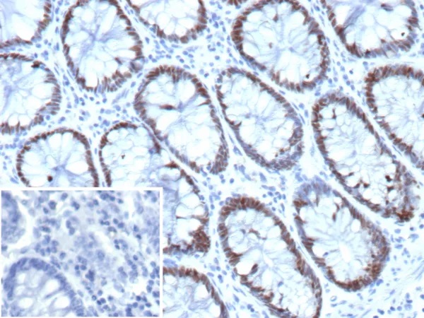 CDX2 / Caudal Type Homeobox 2 (GI Epithelial Marker); Clone CDX2/9338