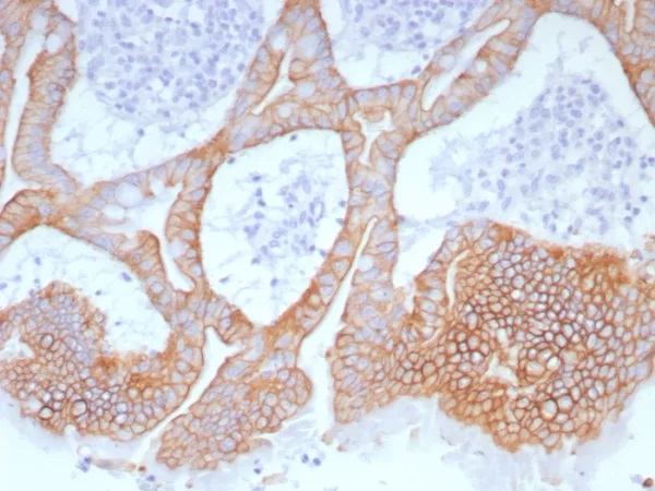 Cytokeratin 15 (Esophageal Squamous Cell Carcinoma Marker); Clone Ks20.8