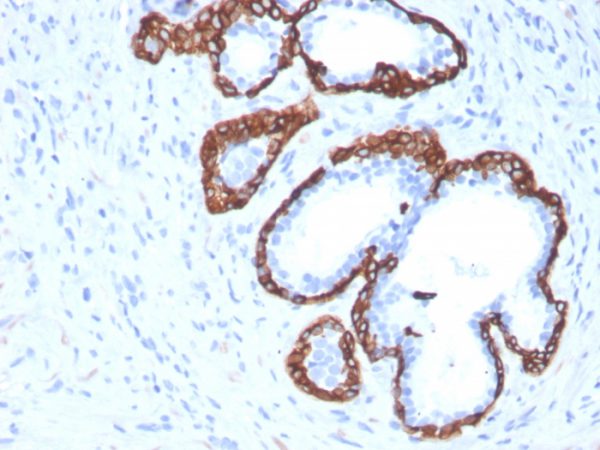 Cytokeratin 5 (KRT5) (Basal, Myoepithelial & Mesothelial Cell Marker); Clone KRT5/3594