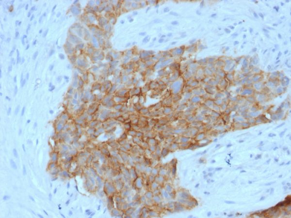 GLUT-1 (Tumor Progression and Mesothelioma Marker); Clone GLUT1/2475