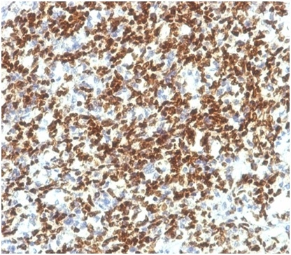 PAX7 (Rhabdomyosarcoma Marker); Clone PAX7/1187