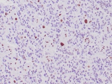 Recombinant ATRX / RAD54 (Alpha Thalassemia Mental Retardation); Clone rATRX/3446