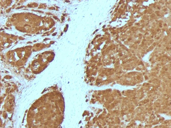 S100B (Astrocyte and Melanoma Marker); Clone 4C4.9 + S100B/1012