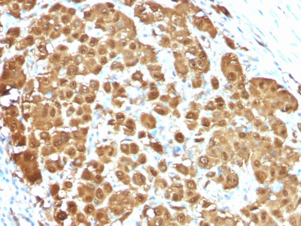 S100B (Astrocyte and Melanoma Marker); Clone S100B/1012