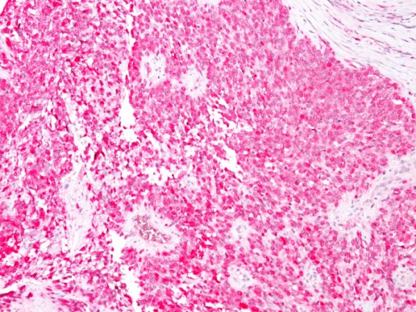 S100B (Astrocyte and Melanoma Marker); Clone 4C4.9