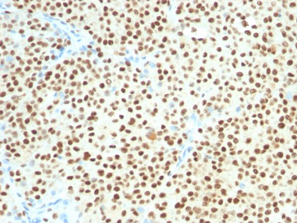 SOX10 (Melanoma Marker); Clone SOX10/1074